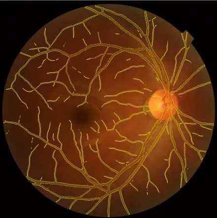 Retinal Blood Vessels